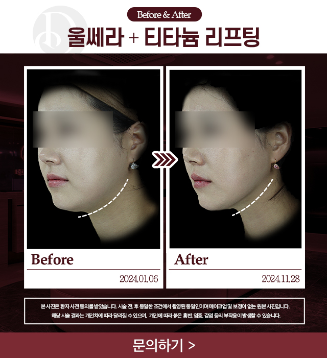 울쎄라+티타늄 리프팅 전후사진