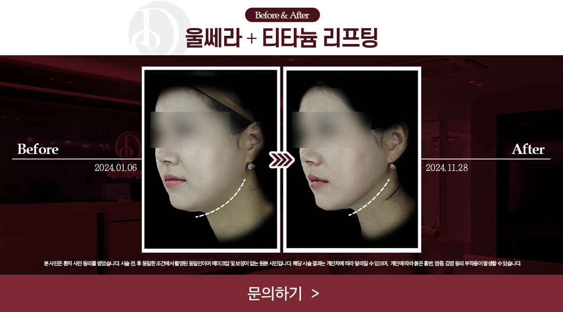 울쎄라+티타늄 리프팅 전후사진
